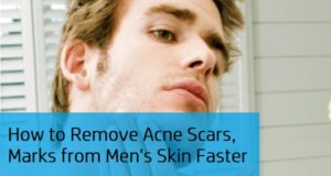 How to Remove Acne Scars, Pimples Marks, Dark Spots from Men's Skin Faster