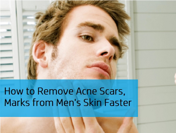 How to Remove Acne Scars, Pimples Marks, Dark Spots from Men's Skin Faster