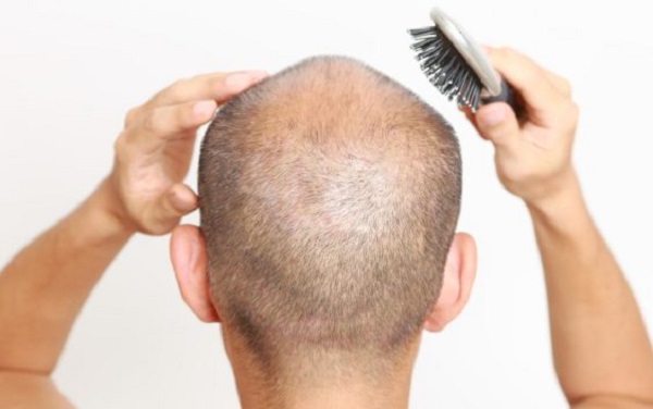 How Men Can Deal with Hair Loss Due to Stress