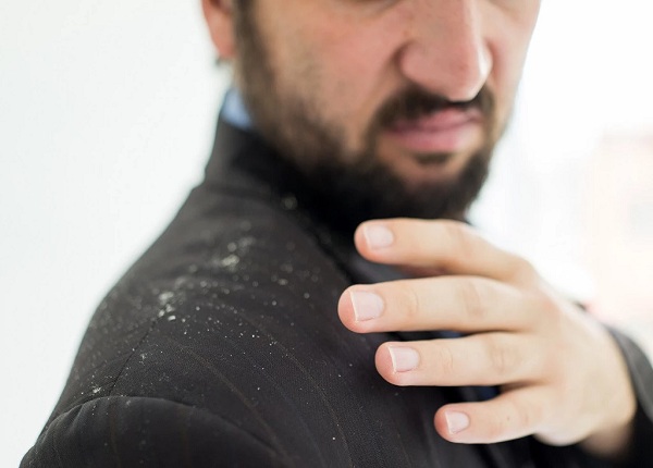 How to Get Rid of Dandruff